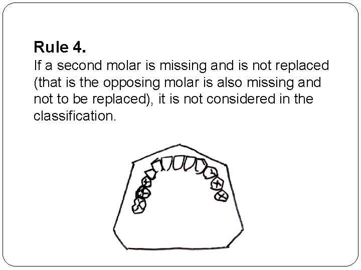 Rule 4. If a second molar is missing and is not replaced (that is