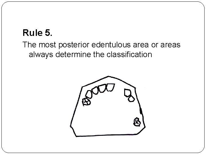 Rule 5. The most posterior edentulous area or areas always determine the classification 