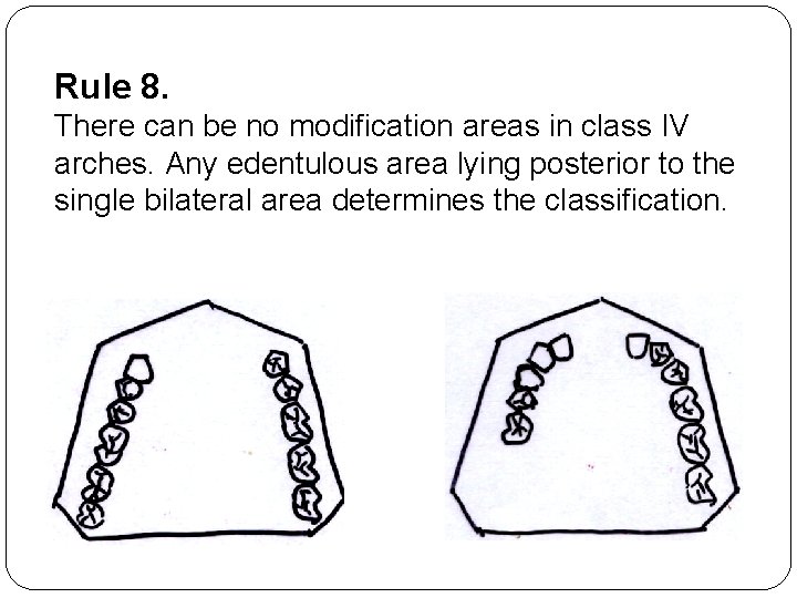Rule 8. There can be no modification areas in class IV arches. Any edentulous
