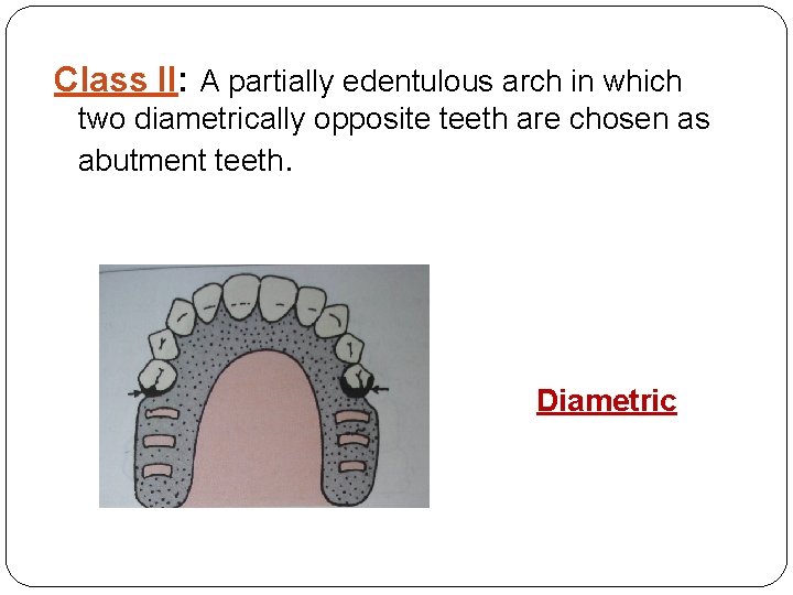 Class II: A partially edentulous arch in which two diametrically opposite teeth are chosen