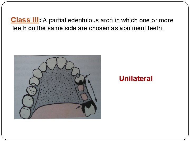 Class III: A partial edentulous arch in which one or more teeth on the