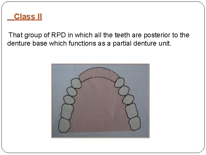 Class II That group of RPD in which all the teeth are posterior to