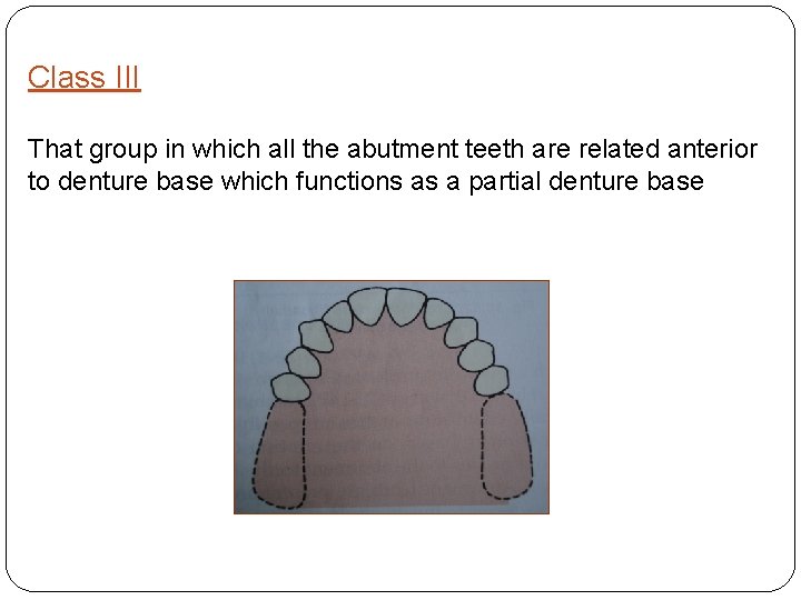 Class III That group in which all the abutment teeth are related anterior to