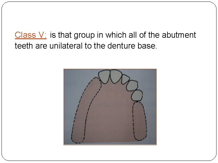 Class V: is that group in which all of the abutment teeth are unilateral