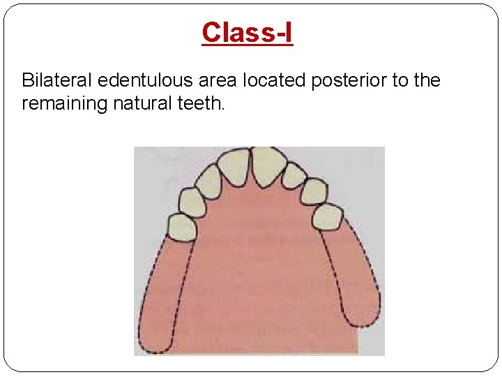 Class-I Bilateral edentulous area located posterior to the remaining natural teeth. 