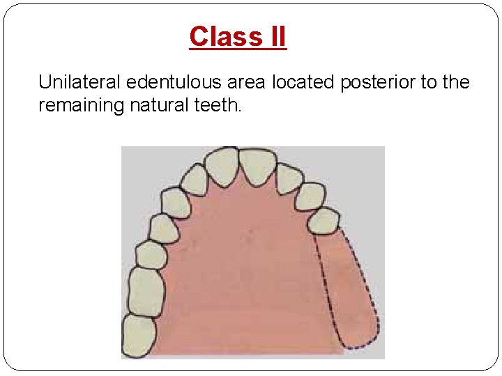 Class II Unilateral edentulous area located posterior to the remaining natural teeth. 