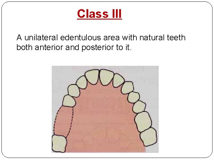 Class III A unilateral edentulous area with natural teeth both anterior and posterior to