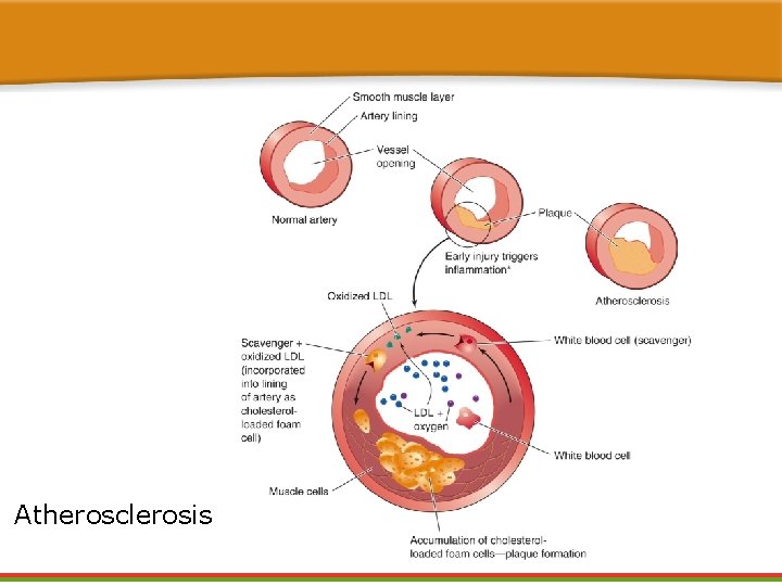 Atherosclerosis 