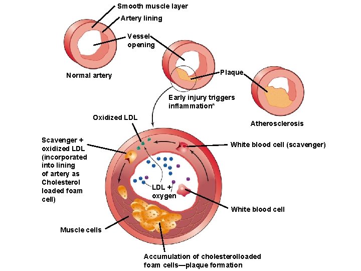 Smooth muscle layer Artery lining Vessel opening Plaque Normal artery Early injury triggers inflammation*