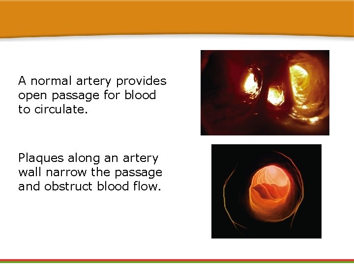 A normal artery provides open passage for blood to circulate. Plaques along an artery