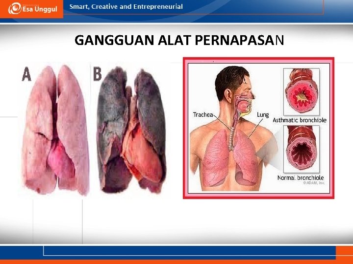 GANGGUAN ALAT PERNAPASAN 