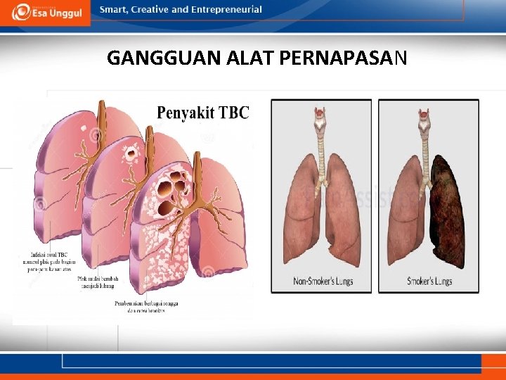 GANGGUAN ALAT PERNAPASAN 