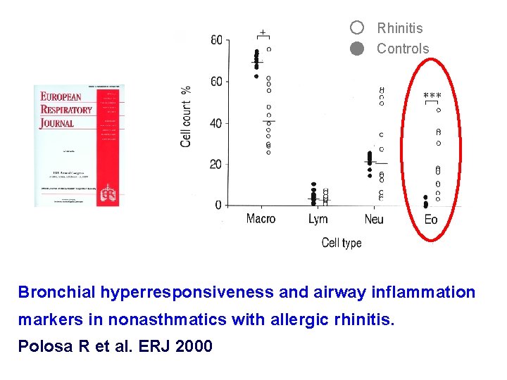 Rhinitis Controls Bronchial hyperresponsiveness and airway inflammation markers in nonasthmatics with allergic rhinitis. Polosa