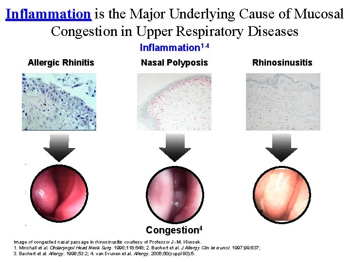 Inflammation is the Major Underlying Cause of Mucosal Inflammation Congestion in Upper Respiratory Diseases
