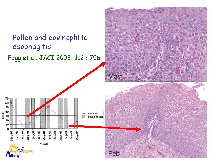 Pollen and eosinophilic esophagitis Fogg et al. JACI 2003; 112 : 796 