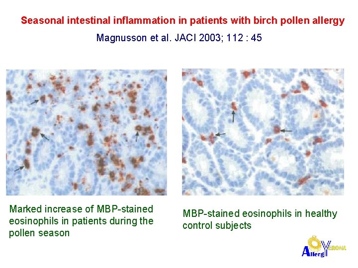 Seasonal intestinal inflammation in patients with birch pollen allergy Magnusson et al. JACI 2003;