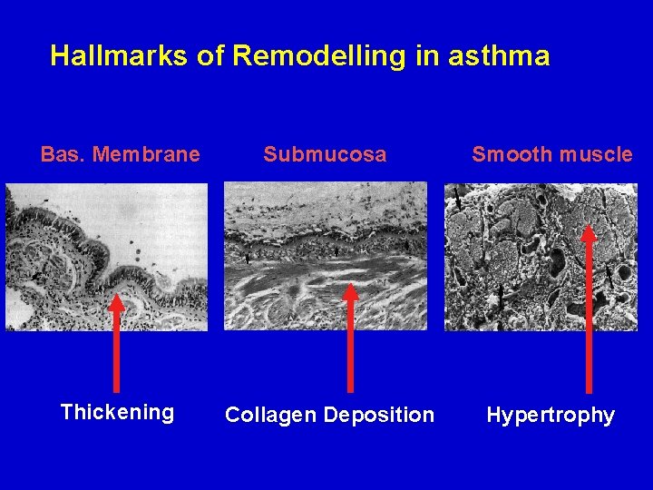 Hallmarks of Remodelling in asthma Bas. Membrane Submucosa Smooth muscle Thickening Collagen Deposition Hypertrophy