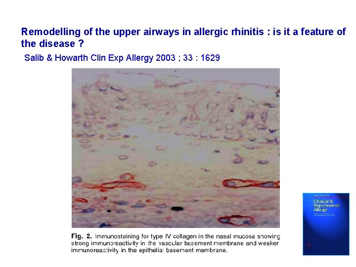 Remodelling of the upper airways in allergic rhinitis : is it a feature of