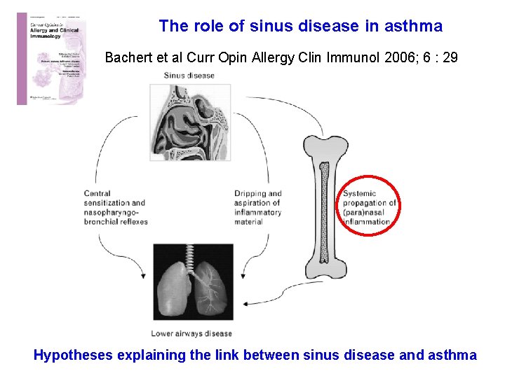 The role of sinus disease in asthma Bachert et al Curr Opin Allergy Clin