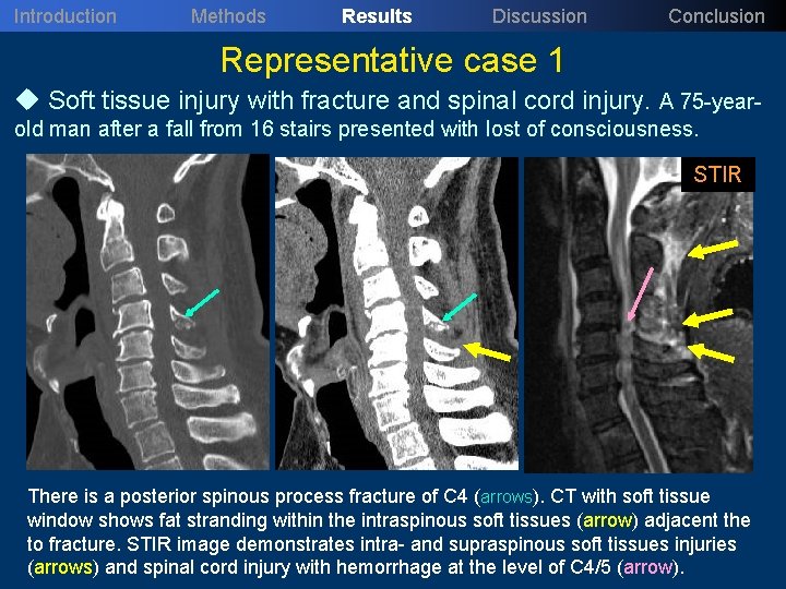 Introduction Methods Results Discussion Conclusion Representative case 1 u Soft tissue injury with fracture