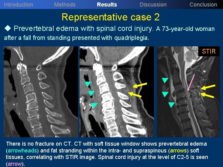 Introduction Methods Results Discussion Conclusion Representative case 2 u Prevertebral edema with spinal cord