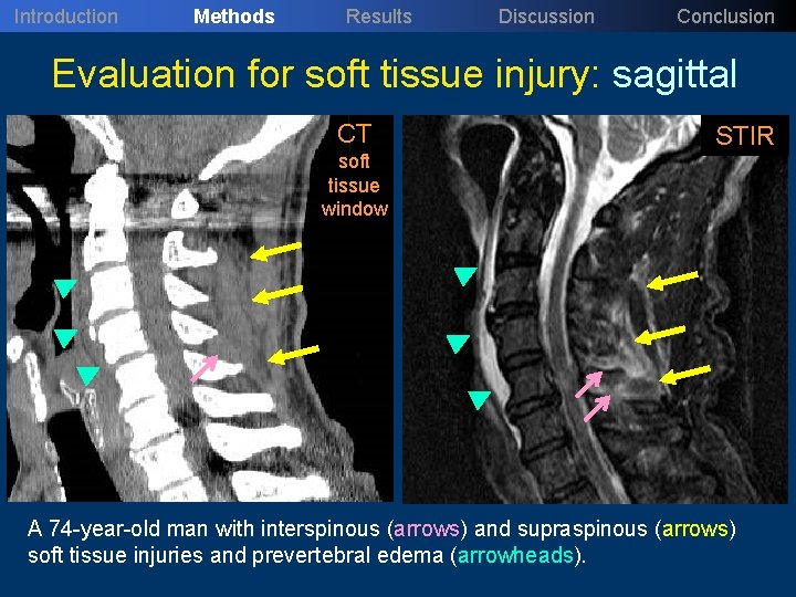 Introduction Methods Results Discussion Conclusion Evaluation for soft tissue injury: sagittal CT soft tissue