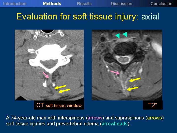 Introduction Methods Results Discussion Conclusion Evaluation for soft tissue injury: axial CT soft tissue