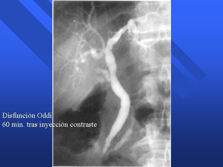 Disfunción Oddi 60 min. tras inyección contraste Disfunción Oddi 60 min. tras inyección contraste