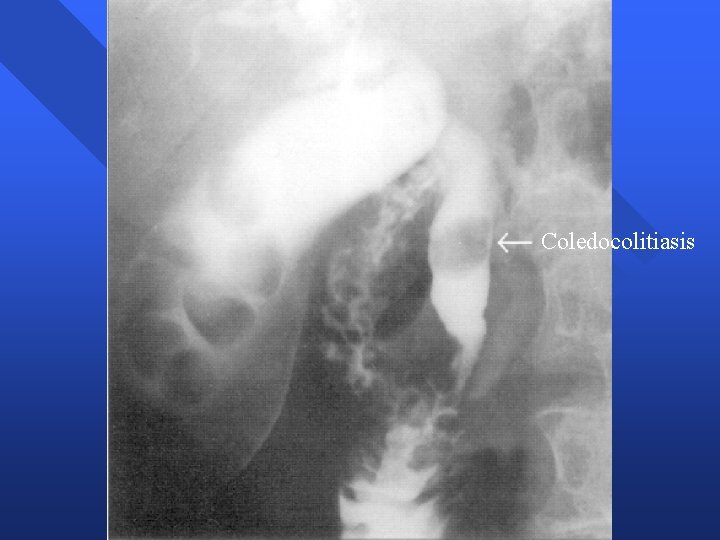 Coledocolitiasis Coledocolitiasis