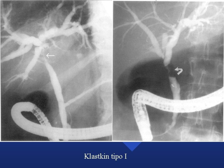 Klastkin tipo I Klastkin tipo I