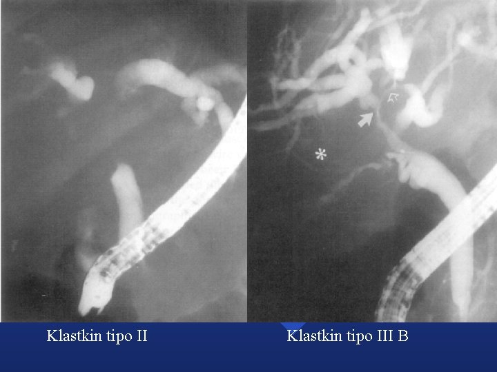 Klastkin tipo III B Klastkin tipo III B