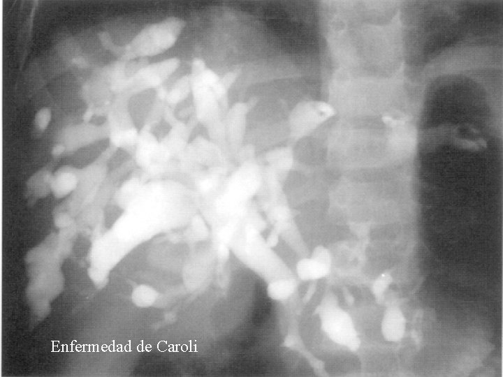 Enfermedad de Caroli Enfermedad de Caroli