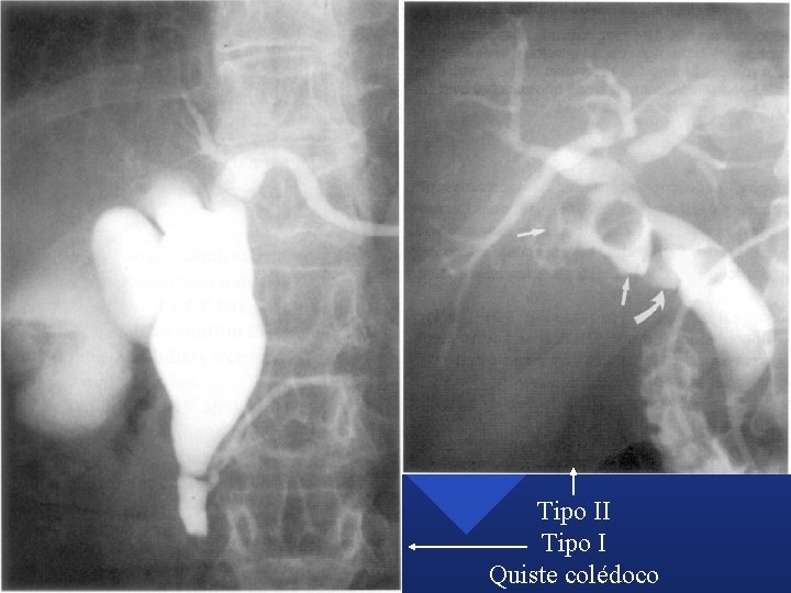 Tipo II Tipo I Quiste colédoco Tipo II Tipo I Quiste colédoco