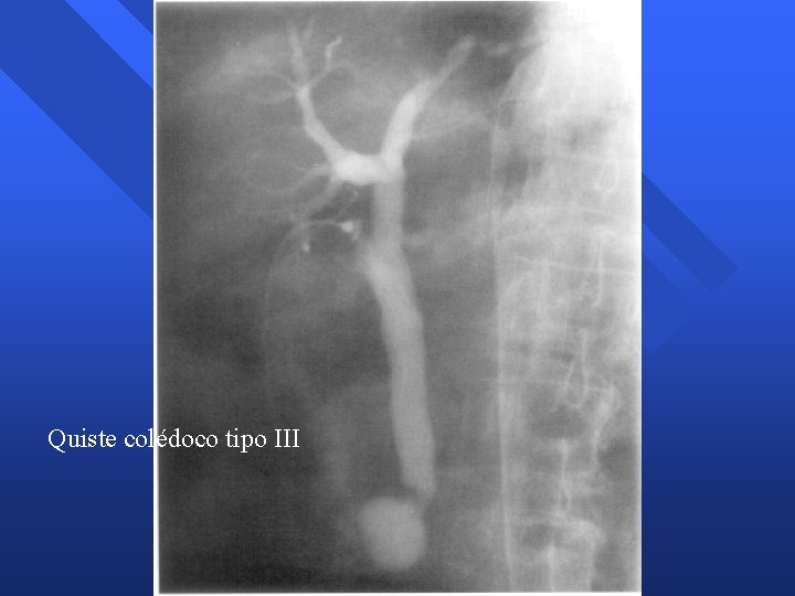 Quiste colédoco tipo III Quiste colédoco tipo III