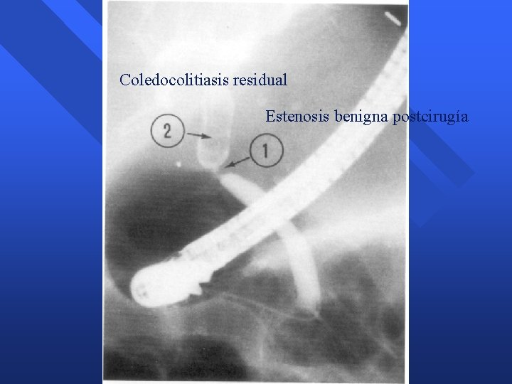 Coledocolitiasis residual Estenosis benigna postcirugía Coledocolitiasis residual Estenosis benigna postcirugía