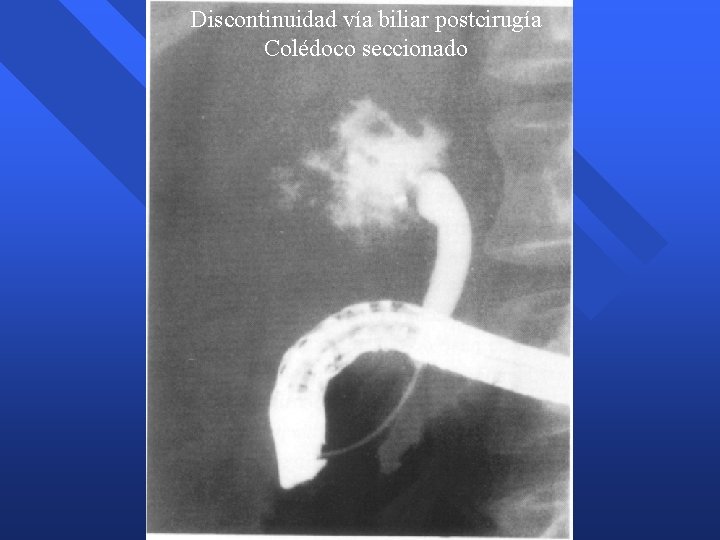 Discontinuidad vía biliar postcirugía Colédoco seccionado Discontinuidad vía biliar postcirugía Colédoco seccionado