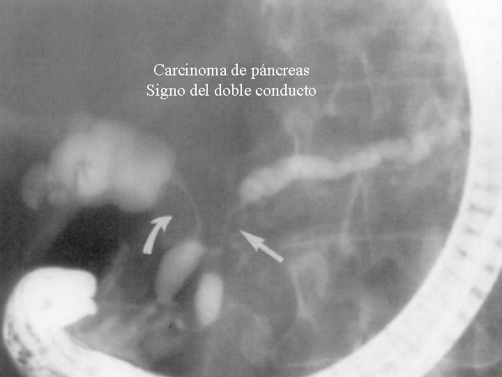 Carcinoma de páncreas Signo del doble conducto Carcinoma de páncreas Signo del doble conducto