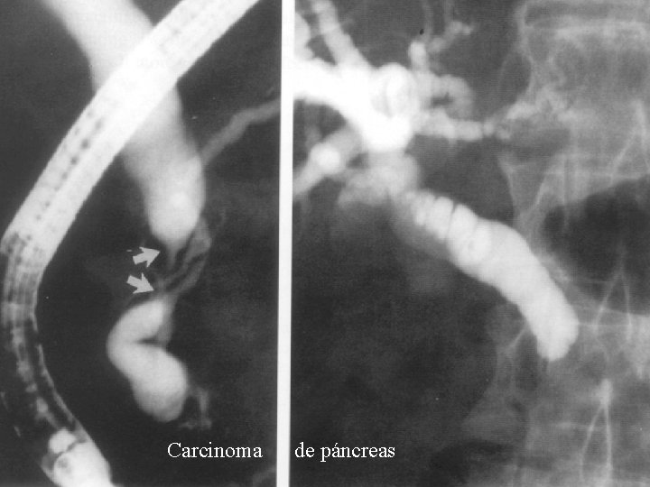 Carcinoma de páncreas Carcinoma de páncreas