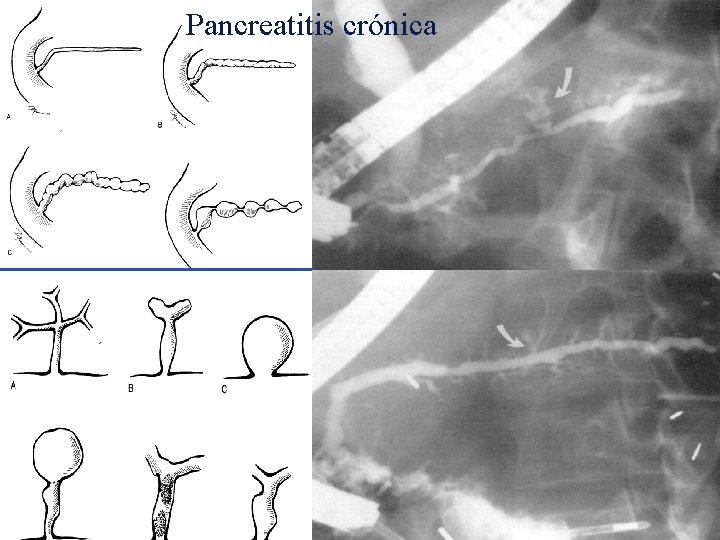 Pancreatitis crónica Pancreatitis crónica