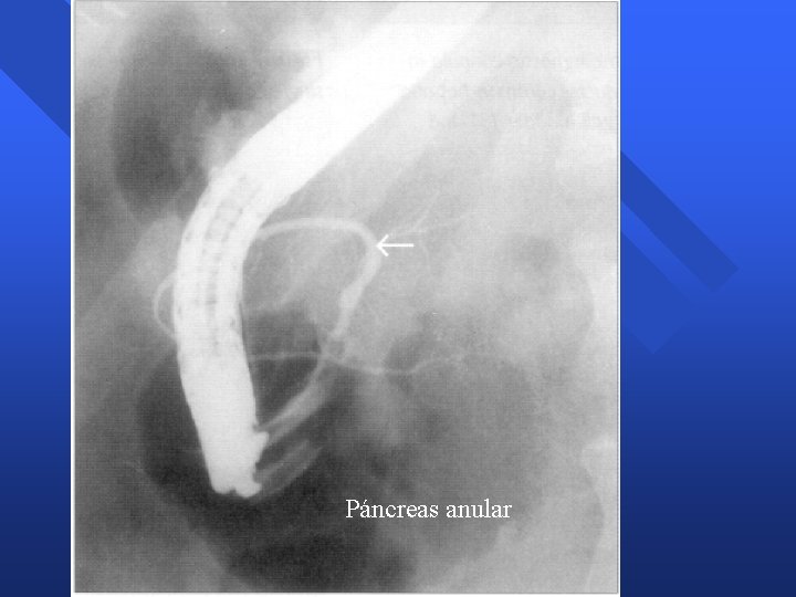 Páncreas anular Páncreas anular
