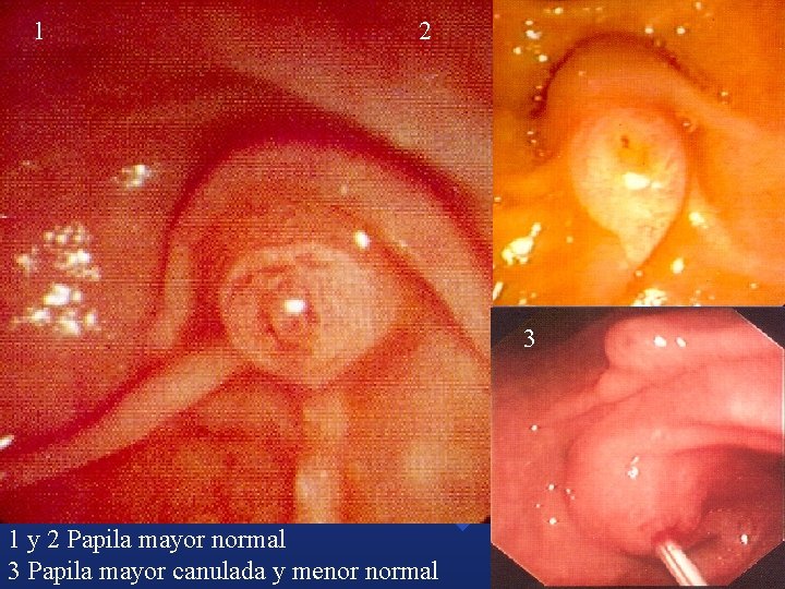 1 2 3 1 y 2 Papila mayor normal 3 Papila mayor canulada y 1 2 3 1 y 2 Papila mayor normal 3 Papila mayor canulada y