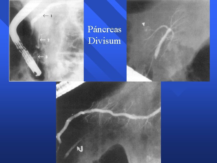 Páncreas Divisum Páncreas Divisum