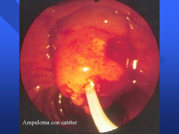 Ampuloma con catéter Ampuloma con catéter