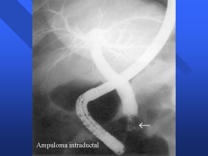 Ampuloma intraductal Ampuloma intraductal