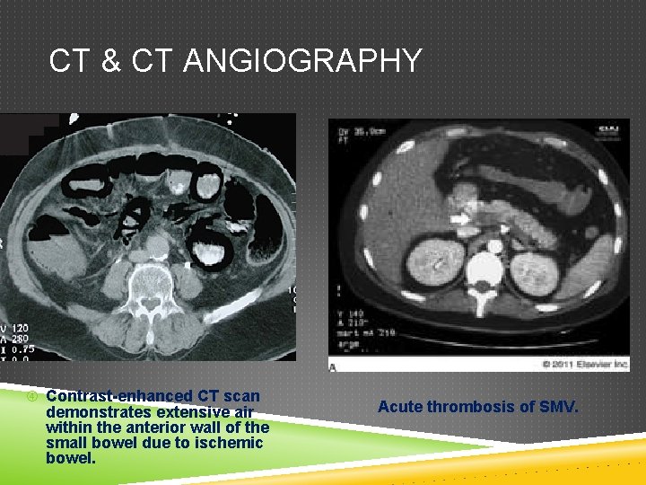 CT & CT ANGIOGRAPHY Contrast-enhanced CT scan demonstrates extensive air within the anterior wall