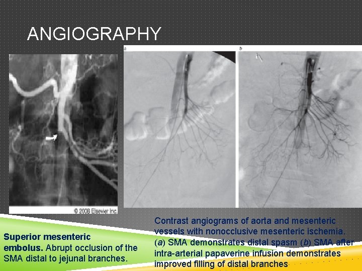 ANGIOGRAPHY Superior mesenteric embolus. Abrupt occlusion of the SMA distal to jejunal branches. Contrast