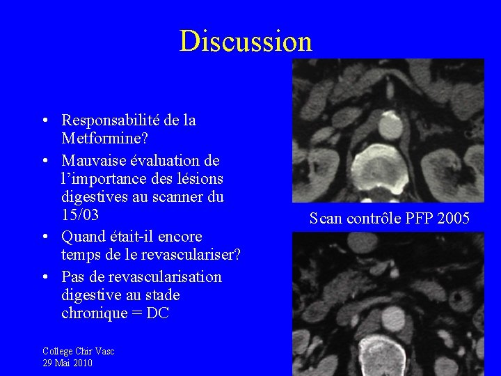 Discussion • Responsabilité de la Metformine? • Mauvaise évaluation de l’importance des lésions digestives