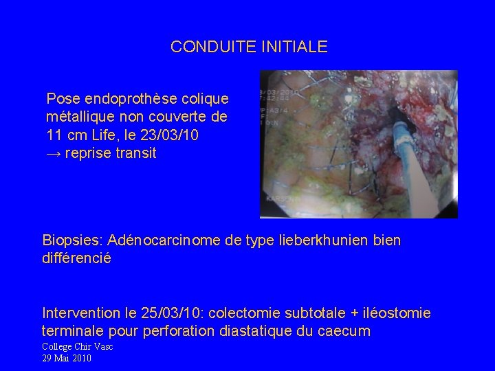 CONDUITE INITIALE Pose endoprothèse colique métallique non couverte de 11 cm Life, le 23/03/10