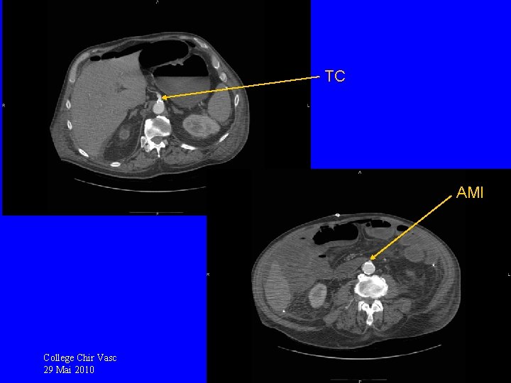 TC AMI College Chir Vasc 29 Mai 2010 TC AMI College Chir Vasc 29 Mai 2010