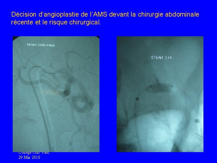 Décision d’angioplastie de l’AMS devant la chirurgie abdominale récente et le risque chirurgical. College